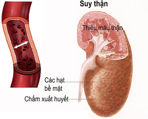 bệnh suy thận